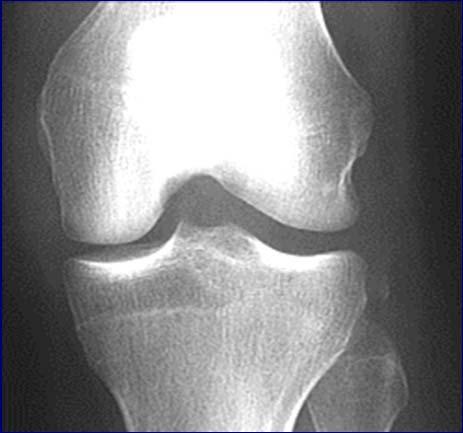 Case #1 diagnosis http://www.ski-injury.com/kneeanat.gif, Accessed 10/04/05. Accessed 10/4/05 A. Patellar tendon rupture B. PCL tear C. ACL tear D. MCL tear E. Meniscus tear F.