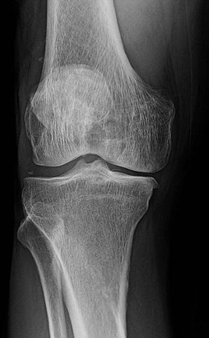 Radiograph 3 views for knee pain Weight bearing flexed PA (aka notch view)