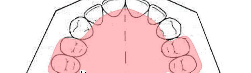 Introduction of a noncompliant molar distalizing appliance the anteroposterior changes. The angles formed between long axes of the teeth with SN were used to determine the amount of their tipping.