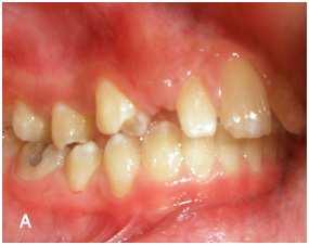 Journal of Dentistry, Tehran University of Medical Sciences Fig 2: A, Occlusal and B, Lateral intraoral photographs of a 12-year-old boy treated with BMD after bonding BMD; C, Lateral photograph