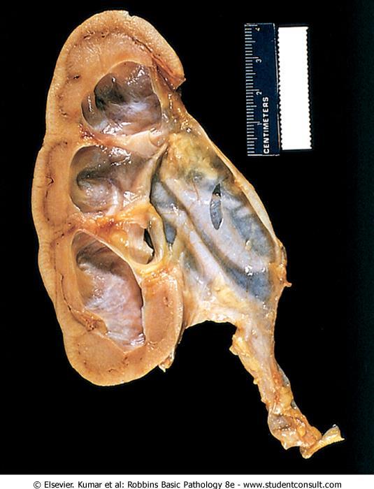 Hydronephrosis of the kidney, with marked dilation of