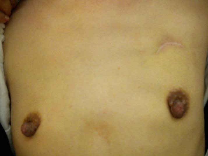 Harvard Breast Cosmesis Score after Breast