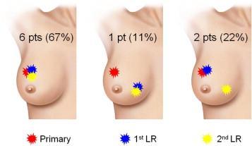 In case of IBTR, lumpectomy plus MCB is feasible and effective in preventing 2nd LR with an OS rate at least