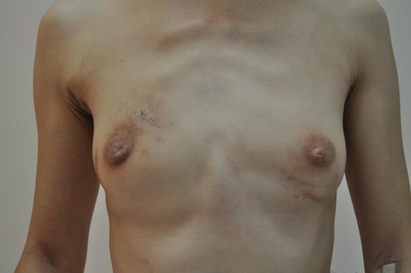 cancer salvage mastectomy