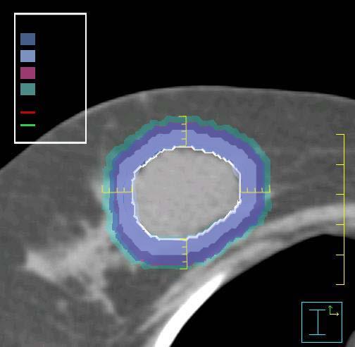 Partial Breast Irradiation -Intraductal Extension- Imamura Data Age > 40 = 8.32mm Ohtake Data Age > 50 = 7.