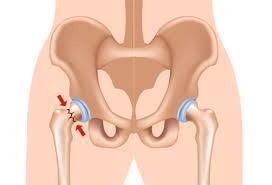 About neck of femur fracture Neck of femur fractures occur in the top of the thigh bone near the ball and socket joint, which forms the hip.