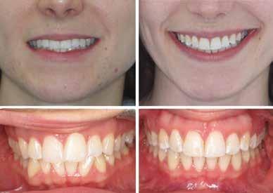 Einstein Orthodontic clinical procedures and esthetic preferences are evolving toward fuller lips, greater enamel display, and wider smiles with a reduced tendency toward fourpremolar extractions,