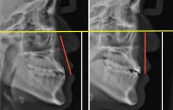 Duncan Brown, 2015) Figure 15: Improved incisor inclination as a result of SAP bracket position, flipped and flocked anterior brackets, Pitts Broad arch forms, and Active Early protocols.