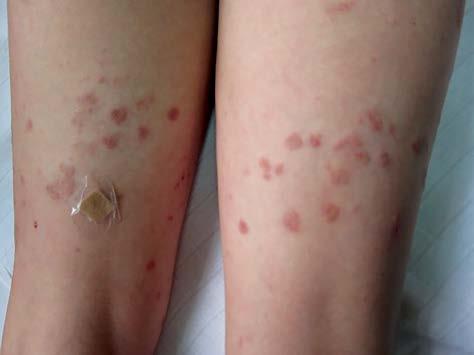 CASE REPORTS Serbian Journal of Dermatology and Venereology 2016; 8 (2): 88-94 Figure 1. Papulonodular and granuloma annulare-like lesions on the thighs Figure 2.