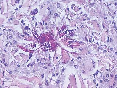 Superficial and deep perivascular and interstitial inflammation composed of eosinophils and lymphocytes, with flame