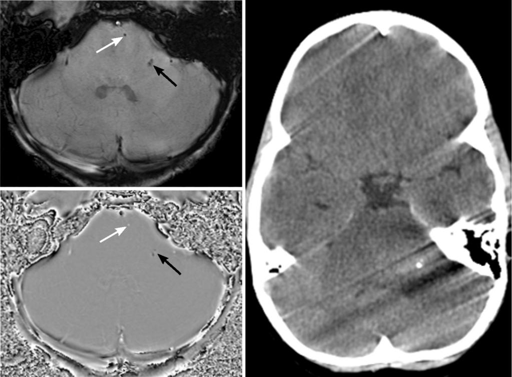 Images for this section: Fig. 0: Hemorrhage (white arrow) and calcification (black arrow) show identical signal properties on magnitude images (left, top).