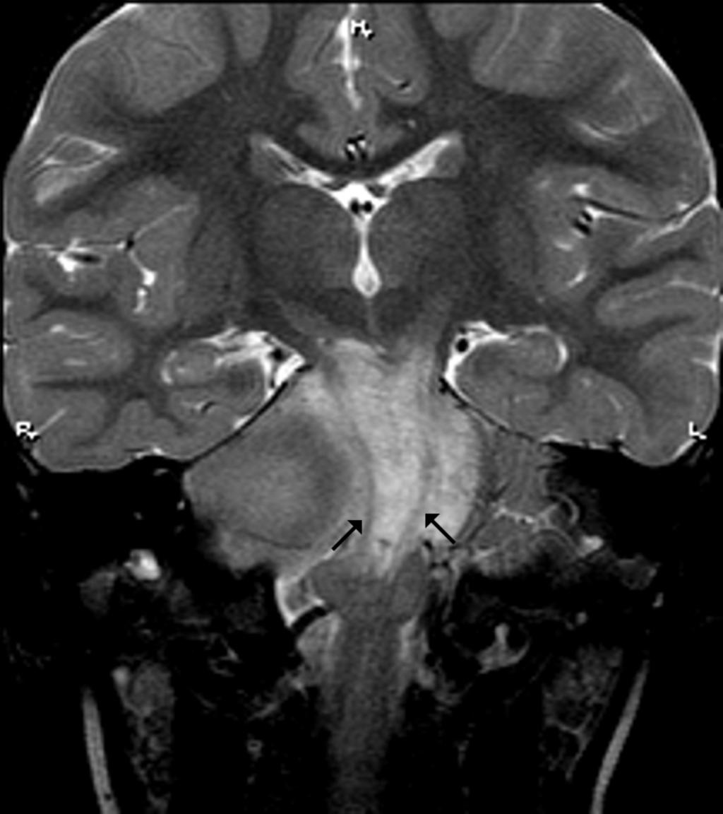 Fig. 0: T2 weighted image of DIPG displacing the corticospinal tracts (arrows).