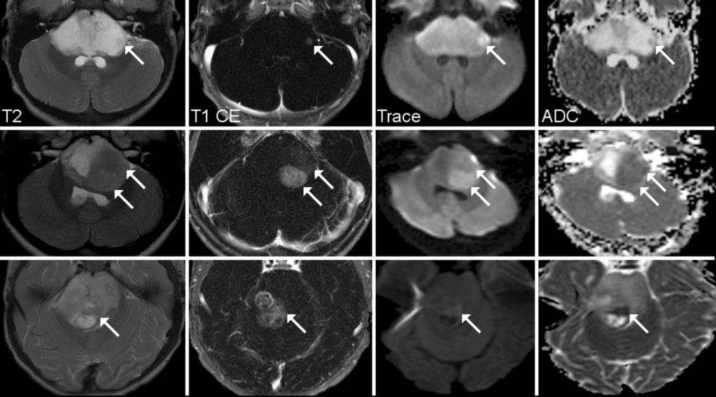 Fig. 0: Varying appearance of T2 hypointense lesions in DIPG presenting with contrast