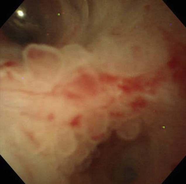 body/tail) 95% 30% 50% 65% Common capsule Yes No Yes N/A Calcification Rare, curvilinear in the No 30e40%, central No cyst wall Gross appearance Orange-like Grape-like Spongy or honeycomb-like