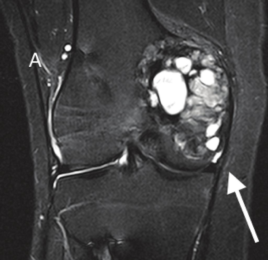 3 (c) (d) Figure 3: MRI of the right knee 4 years after initial presentation demonstrates an expansile multilobulated mass in the medial femoral condyle.