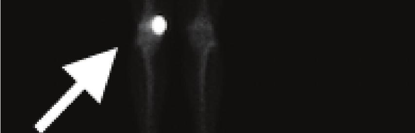 GCTB s typical radiographic findings include a well-defined, expansile, and eccentrically