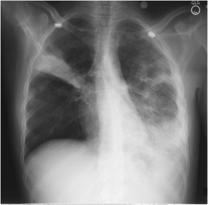 Contact Investigation A 39 year-old female was admitted to a New Jersey hospital with fever, decreased appetite, 11 kg weight loss, cough X 1-3 months, night sweats Chest radiographs were done Sputa