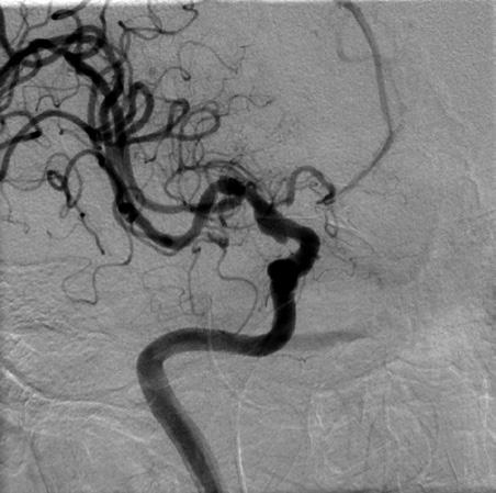These aneurysms develop from the parent artery, irrespective of any bifurcation, forming a broad base, and both the parent artery and the aneurysm exhibit