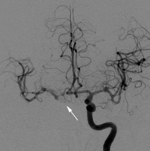 5 seconds later, the venous phase synchronously becomes more evident in both hemispheres (D). This patient had a 1.