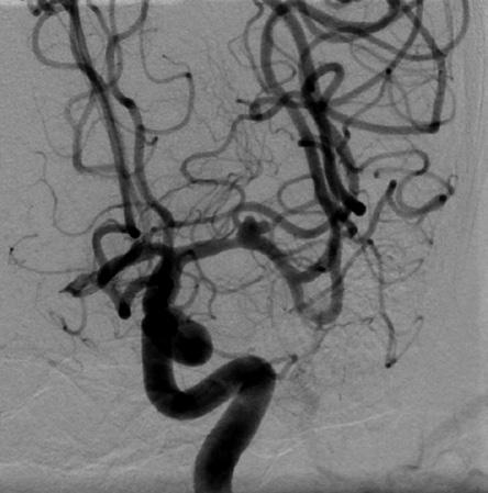 Rethe left was for angiography. Double stents (4.5 30 mm, 4.