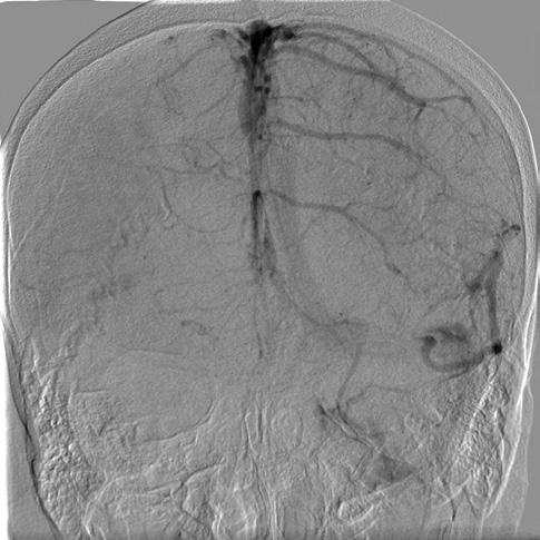DISCUSSION A B C Fig. 1. Initial computed tomography (A) shows diffuse subarachnoid hemorrhage, except left sylvian fissure.