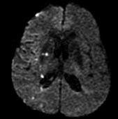 saccular aneurysm at the middle cerebral artery bifurcation (C). A B Fig. 2.