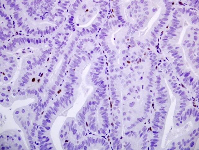 Immunohistochemistry Stain for MLH1,MSH2, MSH6, PMS2 High concordance with MSI assay (>90%) Advantages: Easy availability Efficient testing at the time of histo-reporting Ability to identify which