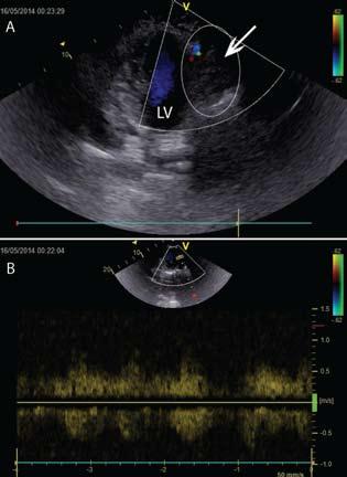 Fig. 1. Transthoracic echocardiography image showing paracardiac tumor mass (within ellipse, marked by arrow) adjacent to the left ventricle (LV) panel A.