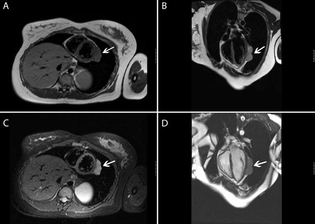 Fig. 3. Magnetic resonance imaging of the heart and paracardiac tumor mass (indicated by arrow).