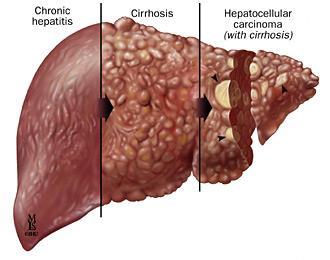 The disease Infectious inflammatory illness of the liver caused by the hepatitis C virus (HCV) Mild resolving illness or progression to chronic disease with permanent