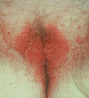 2. L. Morrison, C. LeClair. Red Rashes of the Vulva. Obstet Gynecol Clin N Am 44 (2017) 353-370.