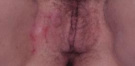 LSC Morphology Exam Findings Erythema Swelling Accentuation of