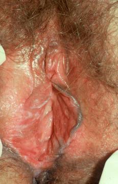 is prominent on vulva