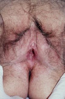 Dermatitis Infectious Subacute/Chronic 50% of chronic vulvovaginal pruritus is ACD or ICD 1 Eczema/Lichen Simplex