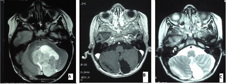 3 Figure 1. (A) MRI- CT Scan of the brain demonstrating a posterior fossa (Vermian) expansive process, with mass effect on V4.