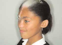 Figure 1: Waardenburg syndrome. A girl with the characteristic white forelock and eyes of a striking ultramarine colour. Patchy depigmentation of the forehead and right eyebrow are evident.
