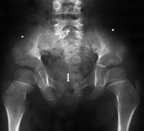 Volume 53 Number 3 A case with OSMED 349 Fig. 4. The anteroposterior radiograph of the pelvis showing slight squared appearance of the iliac wings (stars).