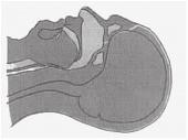 OPEN THE AIRWAY Unconsciousness can lead to loss of tone of the pharyngeal structures responsible for maintaining a patent airway.