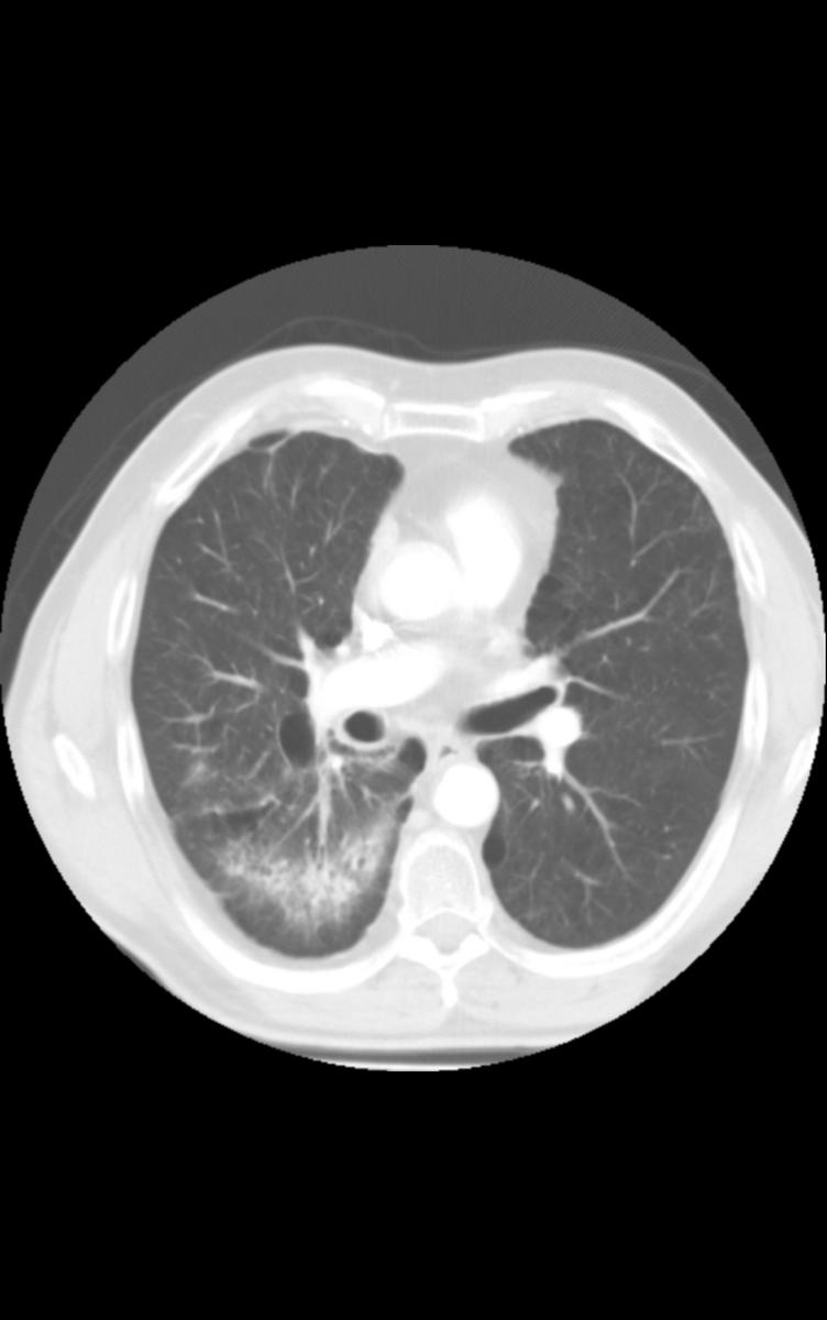 Fig. 6: Axial HRCT of a patient with radiation pneumonitis shows ground-glass,