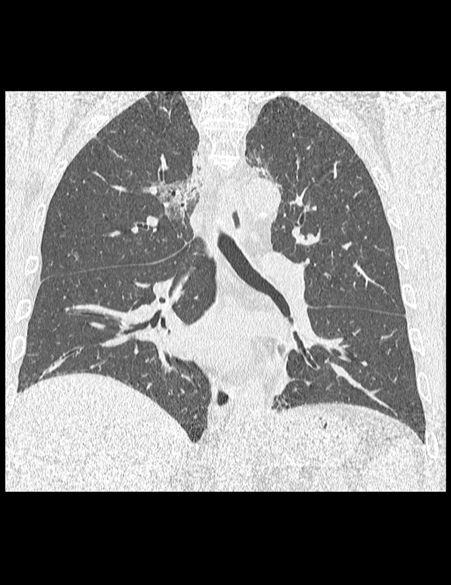 Fig. 7: Coronal HRTC of a patient with radiation pneumonitis shows ground-glass,