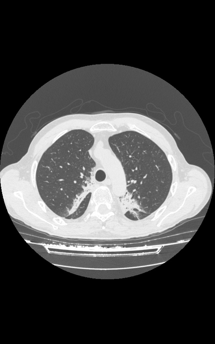 Fig. 9: Axial HRCT of a patient with radiation pneumonitis shows ground-glass,