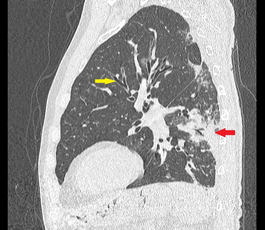 Fig. 4: Sagittal HRCT of a patient with radiation fibrosis shows: consolidation with air