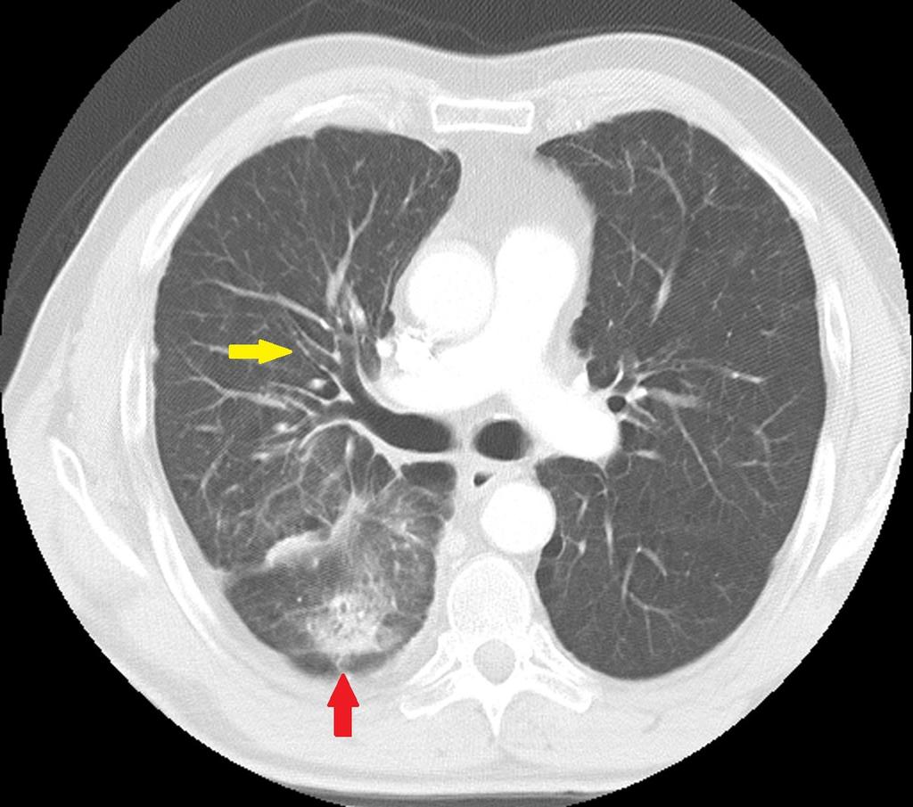 Fig. 5: Axial HRCT of a patient with radiation pneumonitis shows a consolidation with air