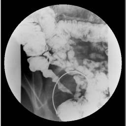 Imaging Small bowel imaging is strongly recommended Especially if unsuccessful ileal intubation Diagnosis is indeterminate Small bowel follow through (SBFT) examination Good for strictures Oldest