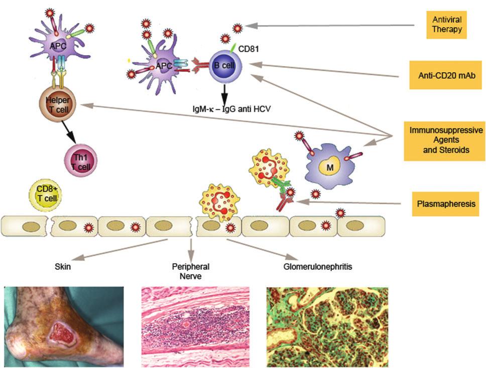 1238 D. Saadoun et al. problems for crafting therapy of HCV-MC have emerged.