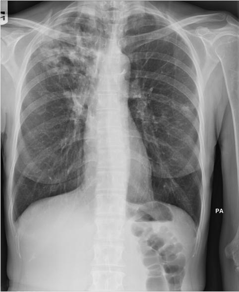 Case 2 Dx: LTBI Rx: Rifampin daily But: Cough is
