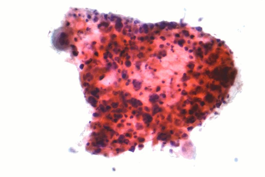 CANCER "Squamous carcinoma lung cytology" by Nephron -