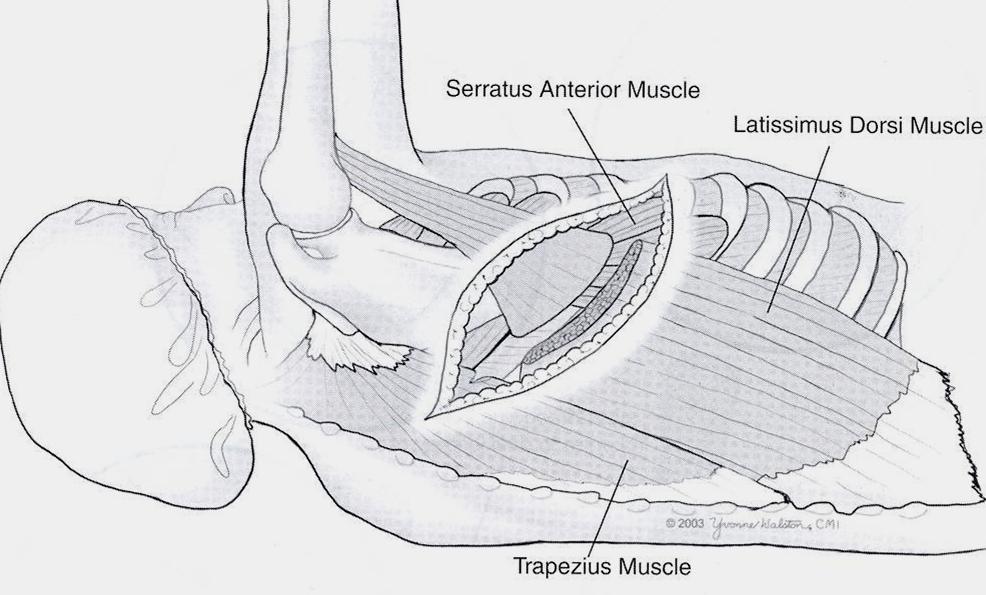 Pancoast tumors use formal posterior lateral Thoracotomy 6-10 cm, predominant lateral incision Minimal rib