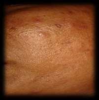 RESULT: 8 Overall Result of Cardinal Symptoms in Percentage:- Scars No Less Moderade Wide Comedones Papules Pustules Nodules Scars BT AT BT AT BT AT BT AT BT AT Complete 00 40 00 30 00 30 00 20 00