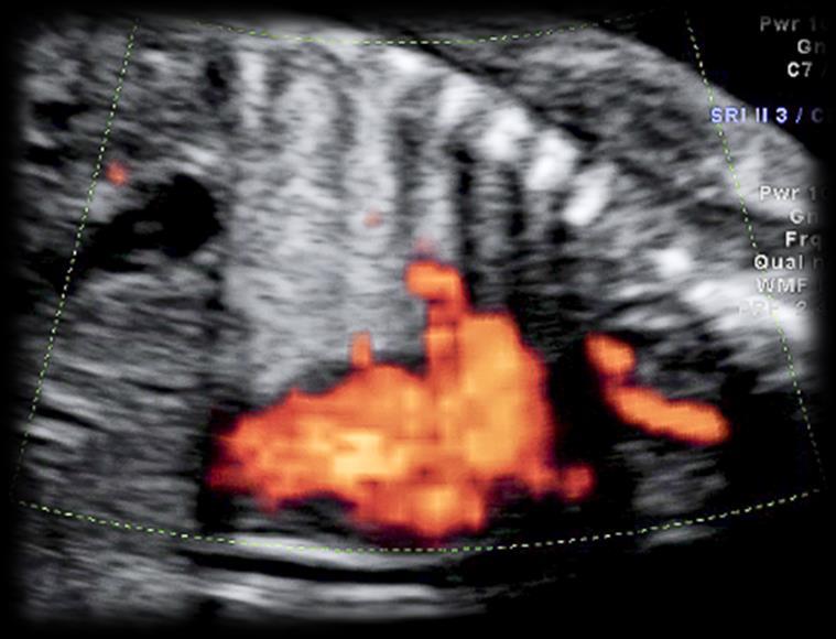 PRENATAL ULTRASOUND Largely performed by our obstetric colleagues However, useful for comparison in fetal MR or in postnatal imaging May show mass-lesions and some vascular malformations